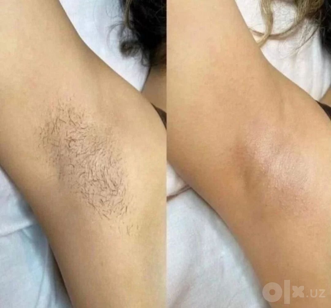 Депиляция всех зон тела для мужчин и женщин