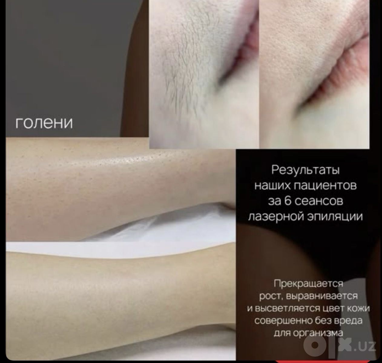 Лазерная эпиляция по доступным ценам