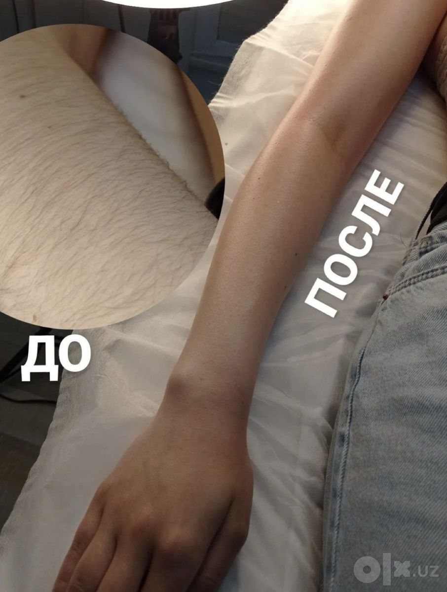 Лазерная эпиляция по доступным ценам