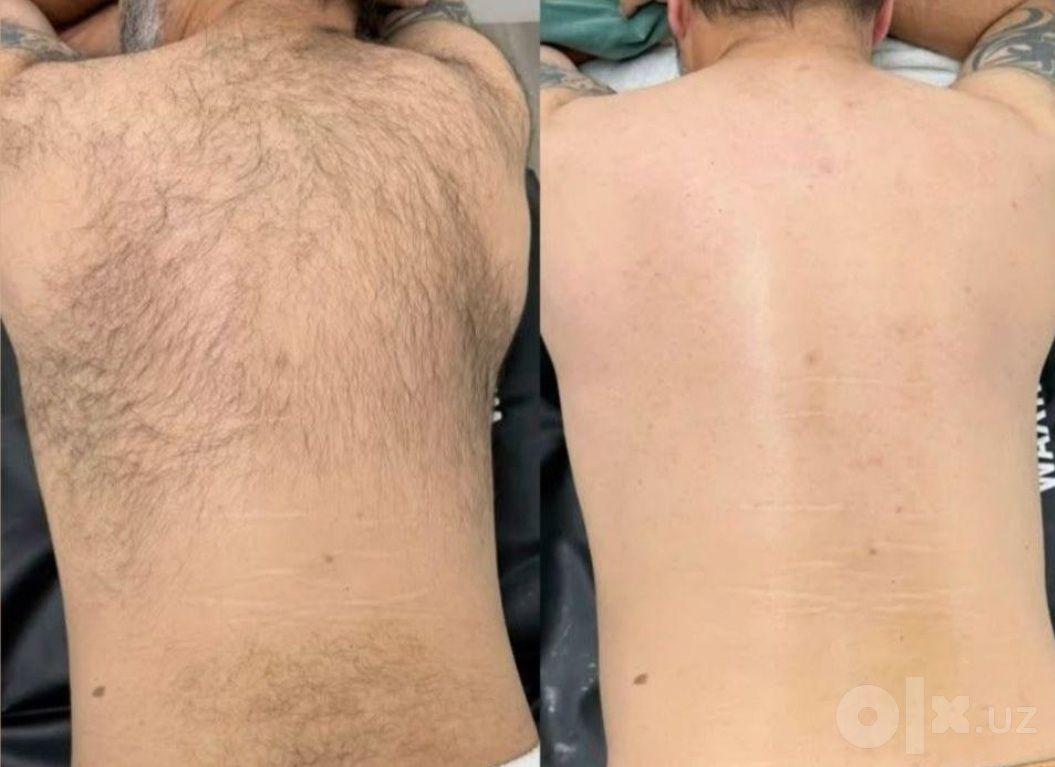Мужская депиляция всех зон тела